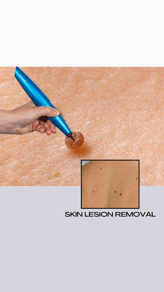Skin lesion removal example with a pen targeting a wart