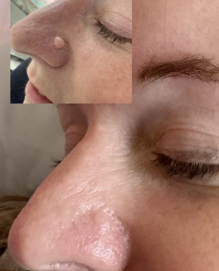 Before and after of a wart removal on the nose
