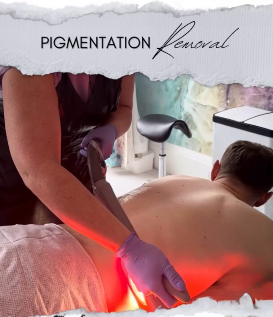 LaserElla performing a pigmentation removal with laser on a client