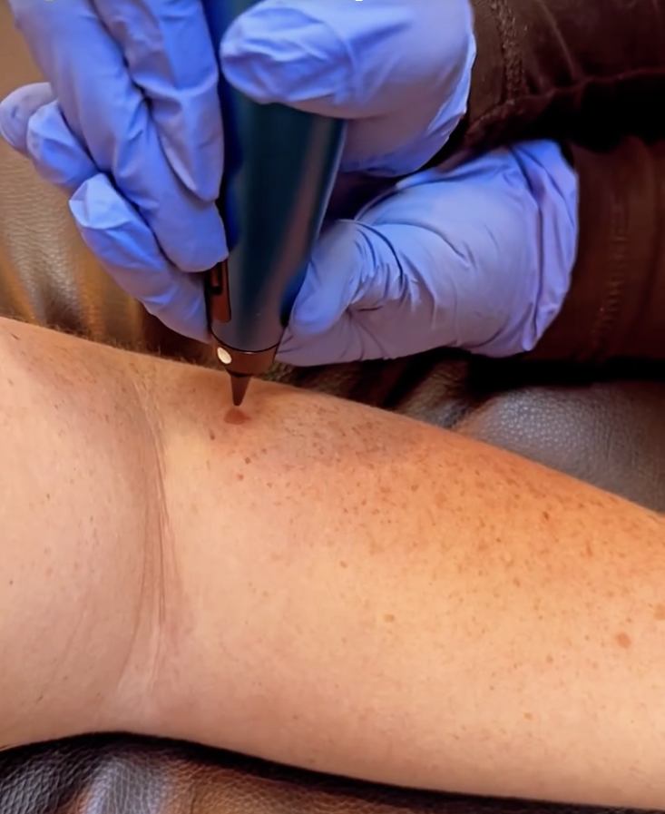 A mole on an arm being removed thanks to a cryopen